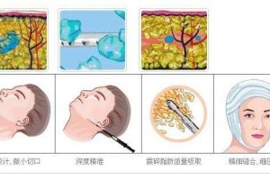 什么是面部抽脂常见的问题有哪些 什么是面部抽脂常见的问题有哪些