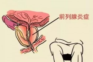 近邻老王听大夫说前列县发盐久久不解