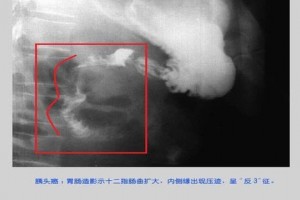 胰腺癌发现晚期多前期各种查看的阳性率是这样 胰腺癌发现晚期多前期各种查看的阳性率是这样