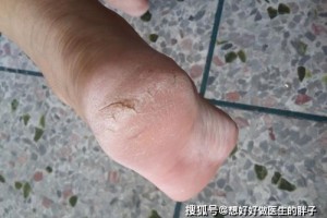 得了糖尿病时脚上会有3个标志期望你一个都没有 得了糖尿病时脚上会有3个标志期望你一个都没有