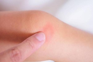 怎么让疤痕不明显提示做好3件事每个细节都至关重要 怎么让疤痕不明显提示做好3件事每个细节都至关重要